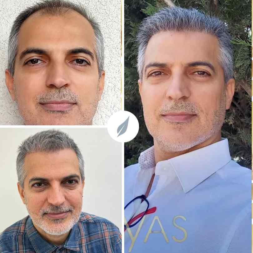 Hair Transplant Before After Turkey | Vita Estetic