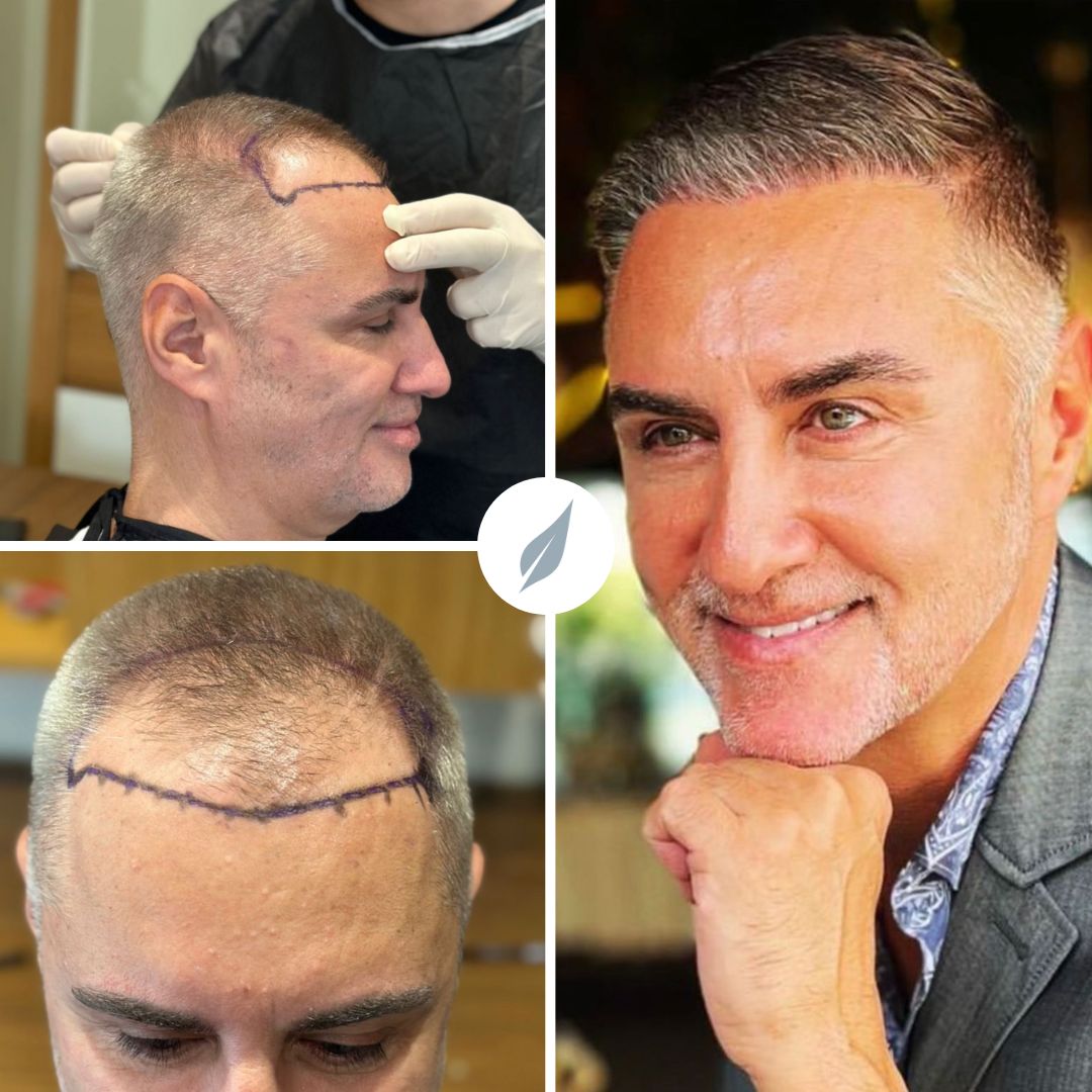 Hair Transplant Turkey Before After | Vita Estetic