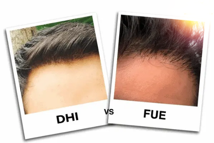 DHI-vs-FUE-Benefits-of-DHI-hair-transplant
